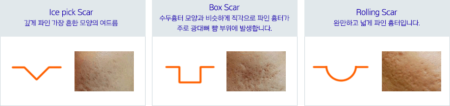 여드름 흉터 치료